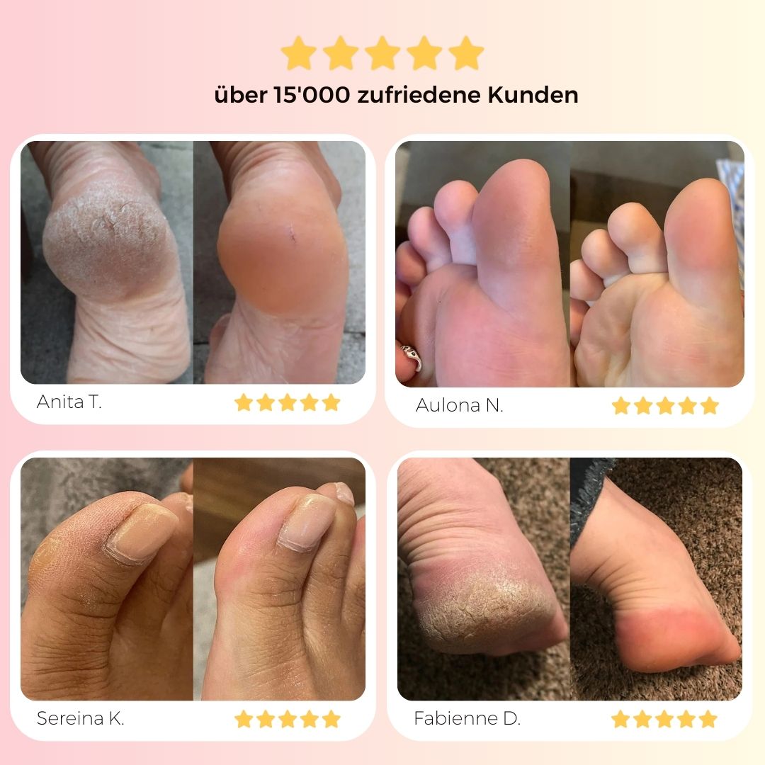 SoftFeet Pro™ - Elektrischer Hornhaut Entferner